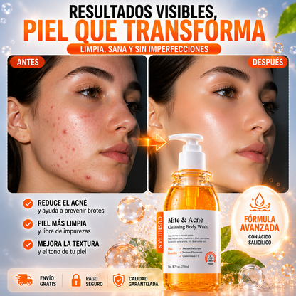 Gel Limpiador Antiacné - Elimina Ácaros, Purifica y Renueva tu Piel